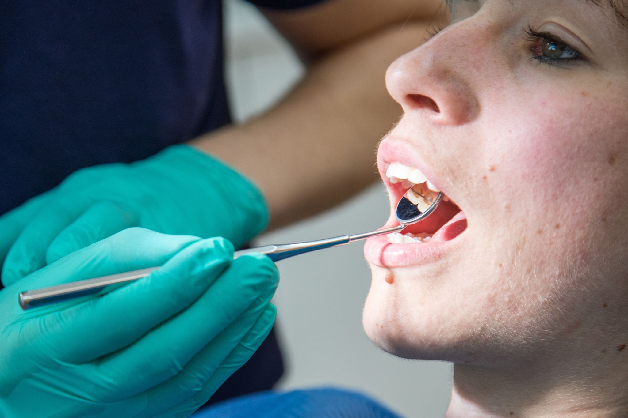 Der Kopf einer Frau mit offenem Mund und Dentalspiegel.